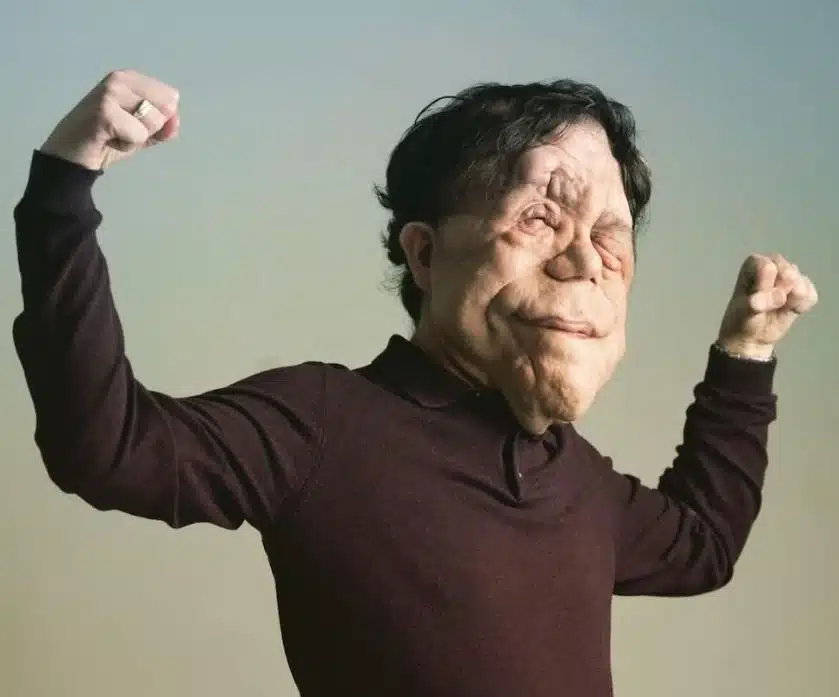 Χαμός στα Όσκαρ: Πασίγνωστος ηθοποιός εμφανίστηκε με αυτό το πρόσωπο και… πάγωσαν όλοι – Η σπάνια αρρώστια που τον «χτύπησε» 5 1773647848748 392251712 22