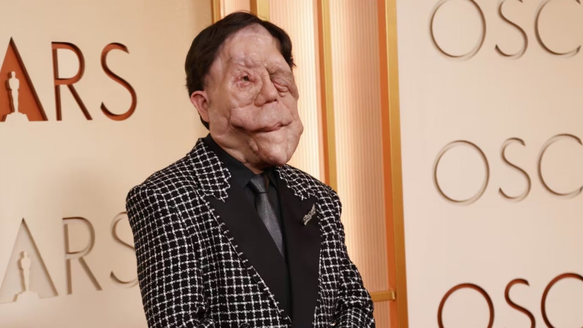 Χαμός στα Όσκαρ: Πασίγνωστος ηθοποιός εμφανίστηκε με αυτό το πρόσωπο και… πάγωσαν όλοι – Η σπάνια αρρώστια που τον «χτύπησε» 6 adam pearson 2